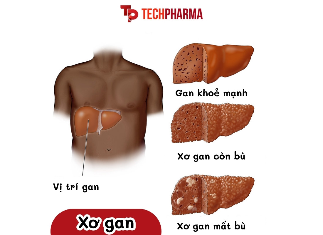 Giai đoạn của xơ gan
